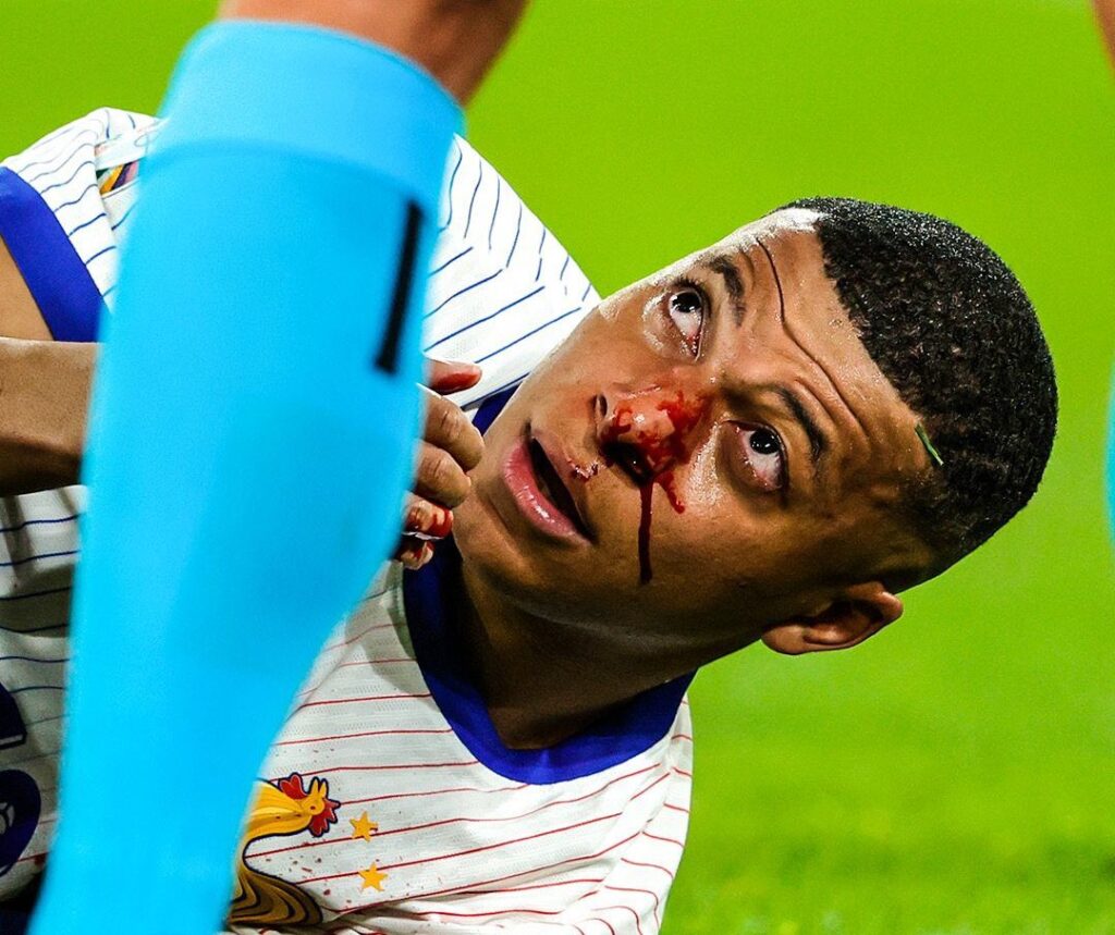 Kylian Mbappe briken nose e1718696712157