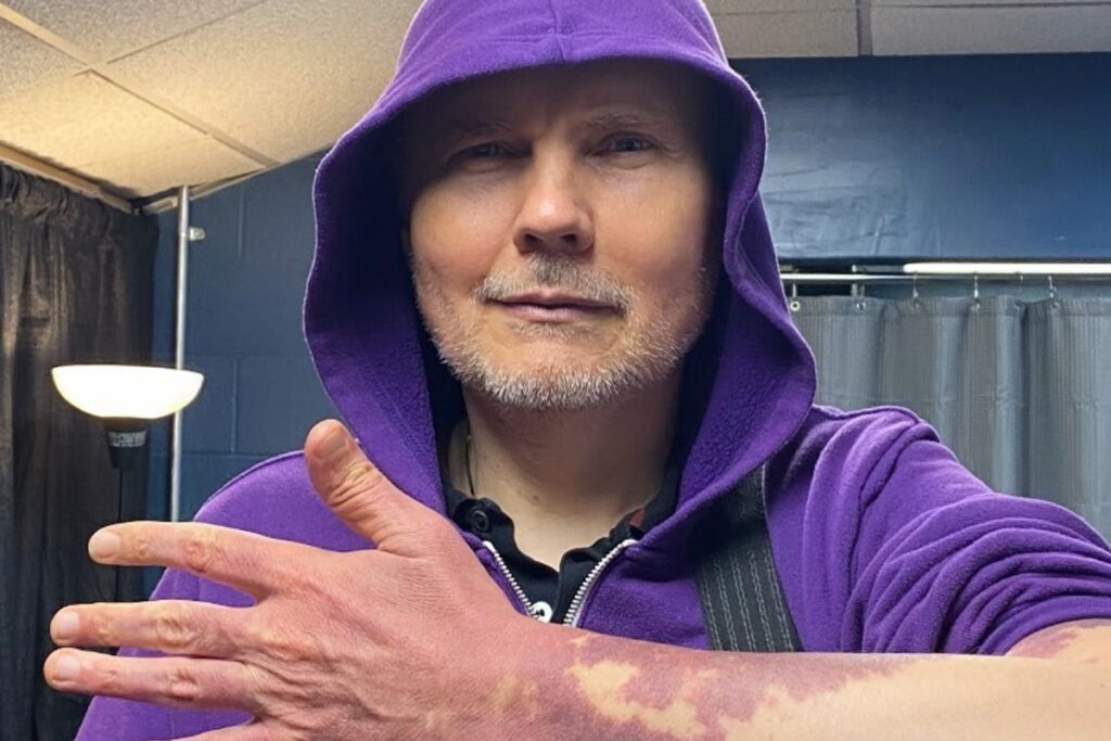 Billy Corgan birthmark 090224 4a99de2b775148e4bb3b12349cd1a71e